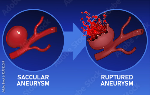 Tablou pe pânză The rupture of aortic aneurysms