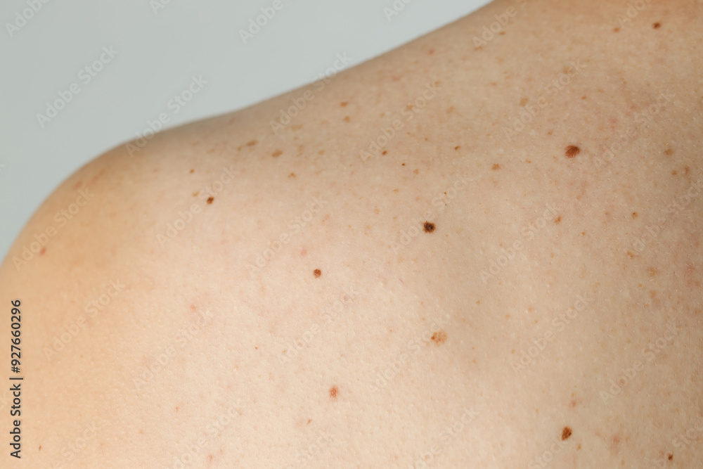 Man with birthmarks on his skin against grey background, closeup Man with birthmarks on his skin against grey background, closeup