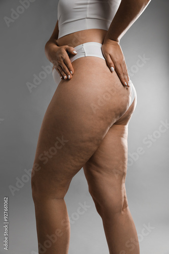 Bild auf Leinwand Woman with cellulite on grey background, closeup