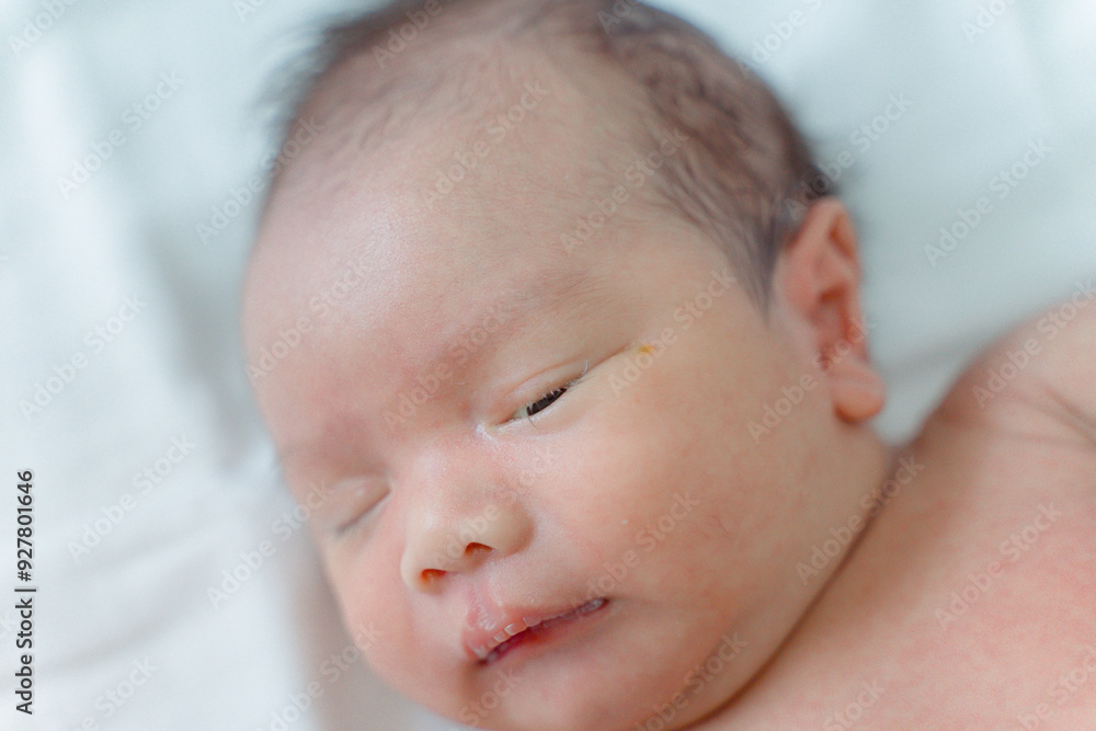 Nasolacrimal duct obstruction, The baby has a blocked tear duct and eye mucus. Nasolacrimal duct obstruction, The baby has a blocked tear duct and eye mucus.