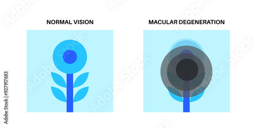 Macular degeneration poster