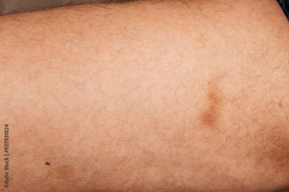 Detailed image of a bruise on the skin, highlighting the human body’s response to minor injury. Detailed image of a bruise on the skin, highlighting the human body’s response to minor injury.