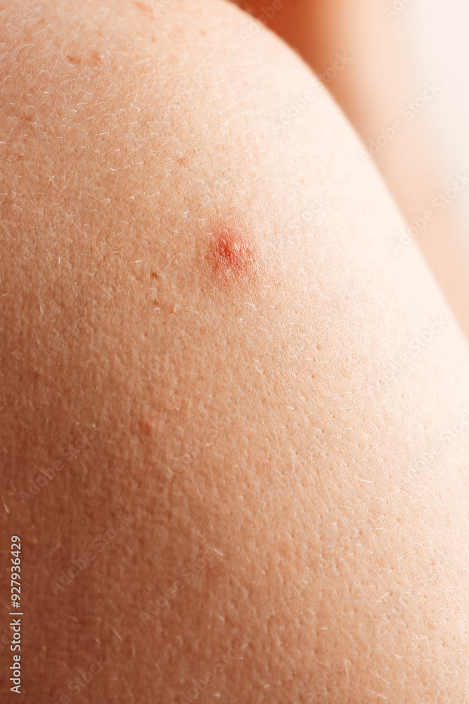 Pimple on skin. Pimple on skin.