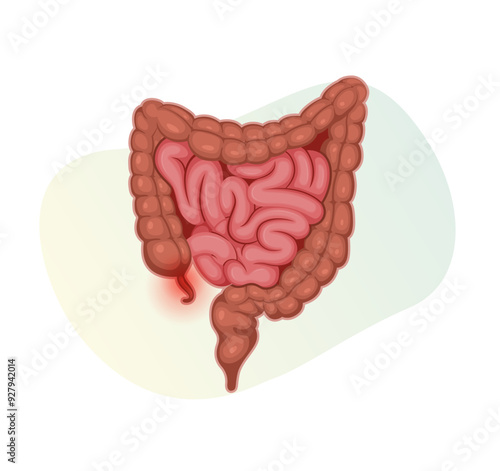  Appendicitis - Inflamed Appendix - Stock Illustration
