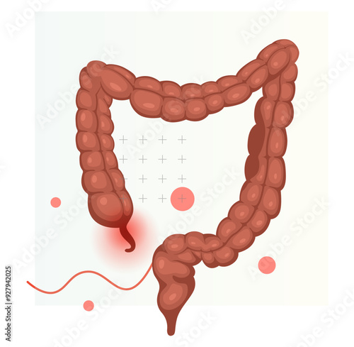  Appendicitis - Inflamed Appendix - Stock Illustration