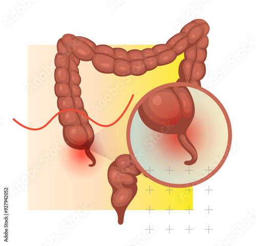  Appendicitis - Inflamed Appendix - Stock Illustration