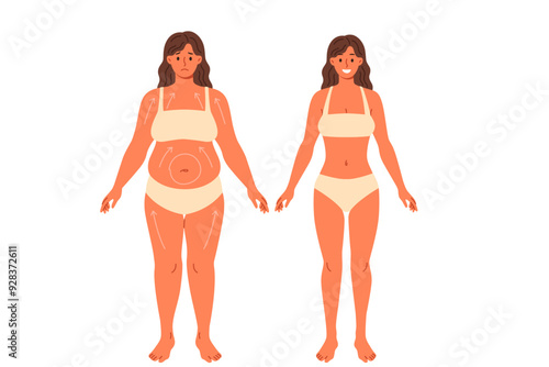 Liposuction for overweight woman posing in underwear before and after surgery. Beautiful girl in need of liposuction demonstrates progress achieved without use of diets and fitness