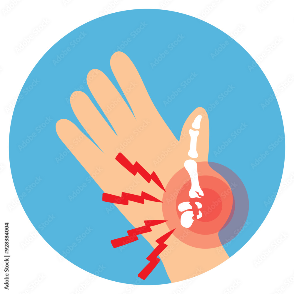 Hand Bone Fracture Illustration Hand Bone Fracture Illustration