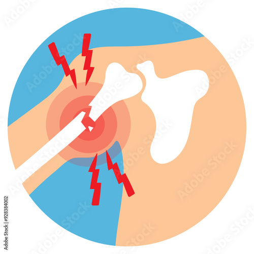 Shoulder Bone Fracture Illustration