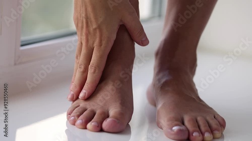 Woman gently touching her leg with large swollen veins. 4K