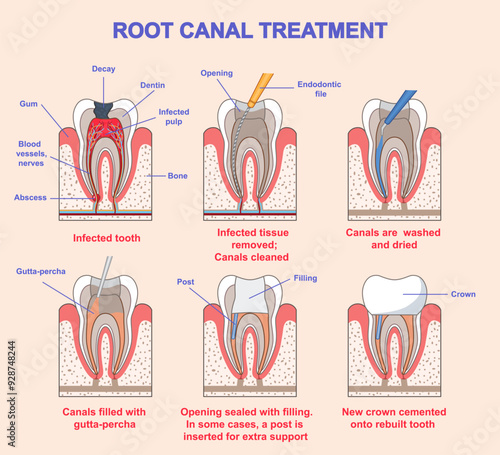 Root canal treatment. Medical infographic or diagram with stages of dental treatment. Diagnostics and filling of teeth damaged by caries. Dentistry and healthcare. Flat vector illustration