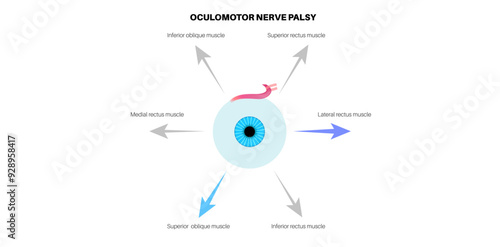 Oculomotor nerve palsy