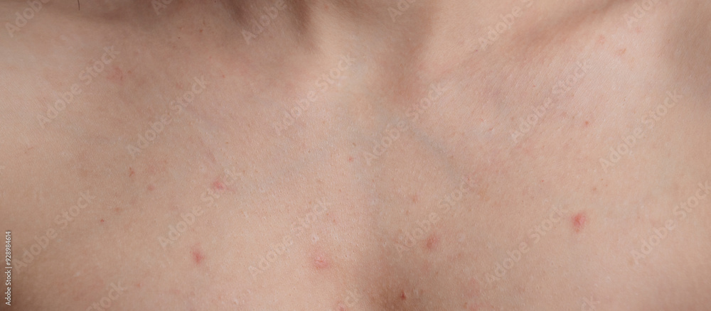 A close-up of a panoramic shot of a woman's skin prone to acne and other dermatological problems. A close-up of a panoramic shot of a woman's skin prone to acne and other dermatological problems.
