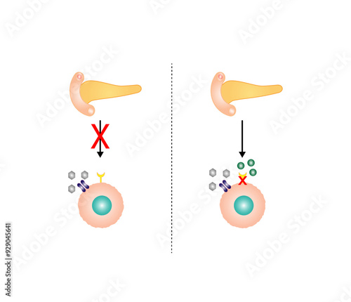 Diabetes mellitus type 1, pancreas's failure to produce enough insulin and type 2, cells fail to respond to insulin (Insulin resistance). Result in high blood glucose levels. Vector illustration.