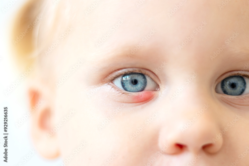 Children's right eye and swollen barley on the lower eyelid. Macro, close-up Children's right eye and swollen barley on the lower eyelid. Macro, close-up
