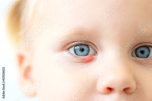 Obraz na płótnie Children's right eye and swollen barley on the lower eyelid. Macro, close-up w salonie