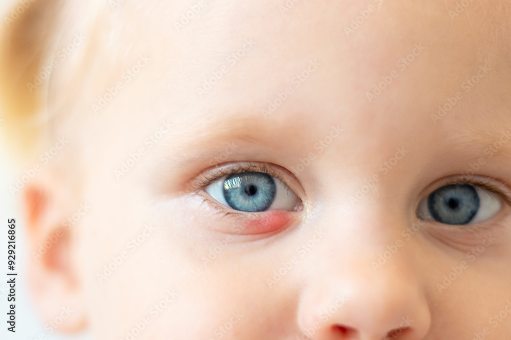 Children's right eye and swollen barley on the lower eyelid. Macro, close-up Children's right eye and swollen barley on the lower eyelid. Macro, close-up