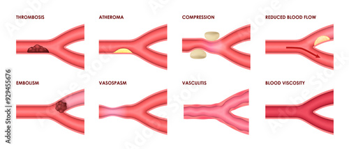 Vein diseases of thrombosis, atheroma and vasculitis with blood viscosity, vector medical infographic icons. Vein diseases of vascular artery compression, vasospasm, embolism and reduced blood flow