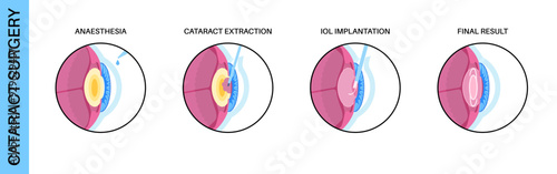 Cataract surgery poster