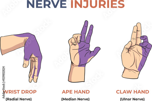 Illustration of nerve injuries in hand