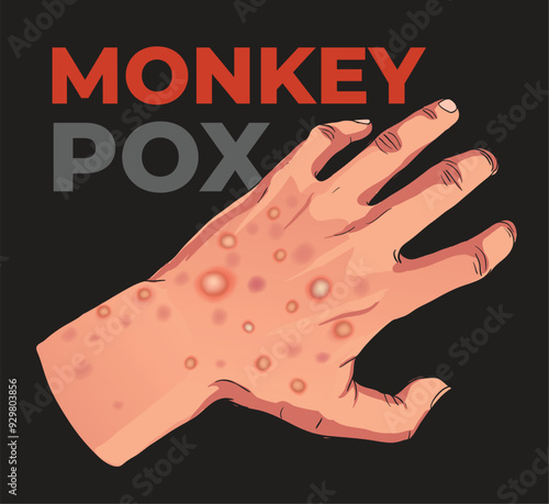 illustration of monkey pox rash in hand