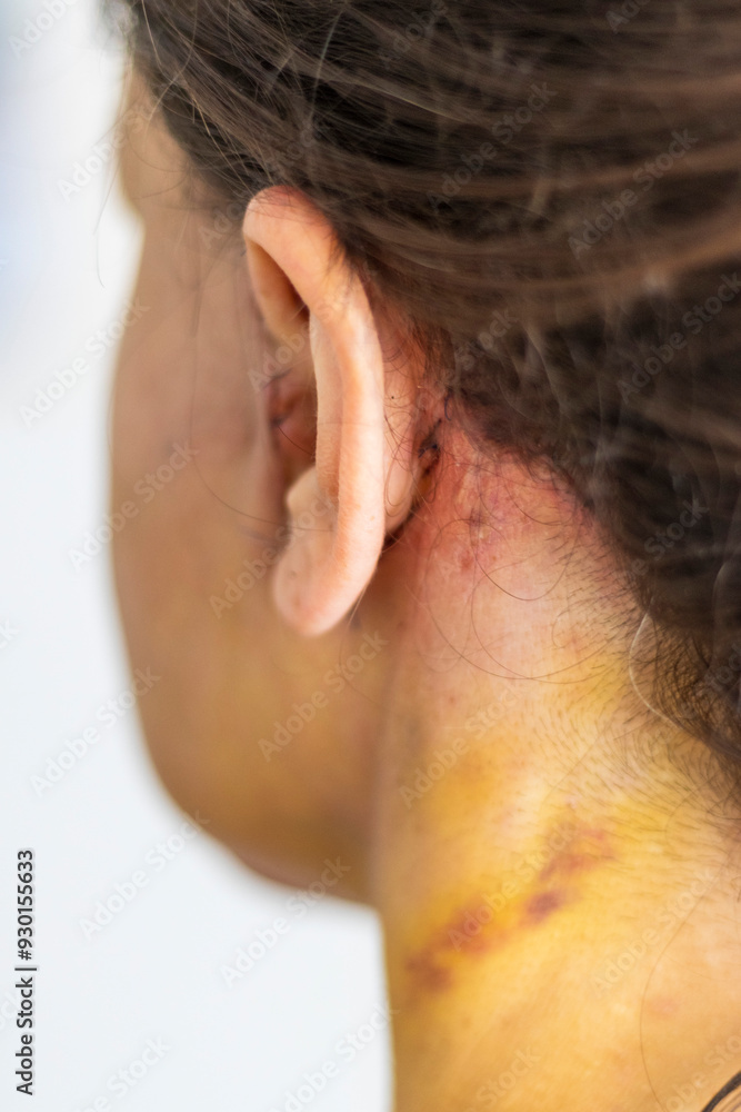 Fototapeta premium Shot of the stitches and scars on woman head after cosmetic surgery. Healthcare