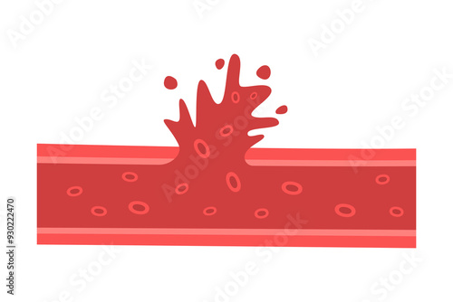 vessel with fat blocked blood flow