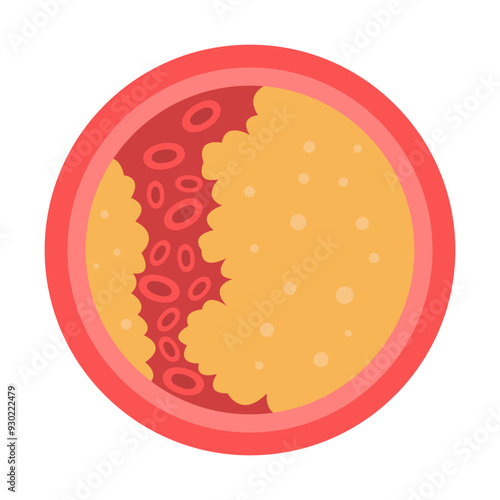 vessel with fat blocked blood flow