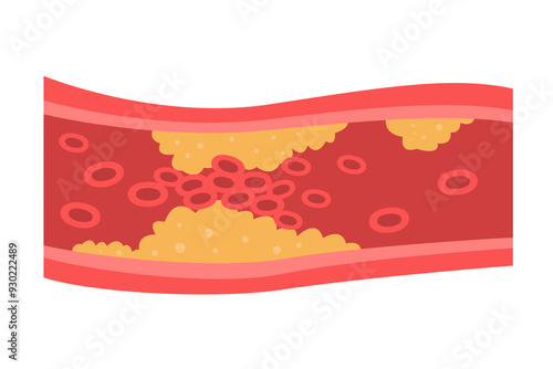 vessel with fat blocked blood flow