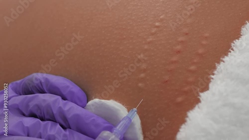 Aesthetic procedure for removing striae with a syringe, performed by a professional, close up. Stretch mark removal procedure on skin with injections in a cosmetic clinic photo