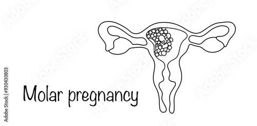 Molar pregnancy