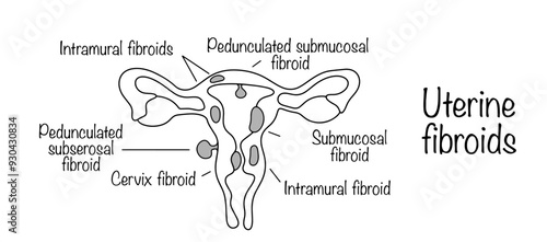 Uterine fibroids