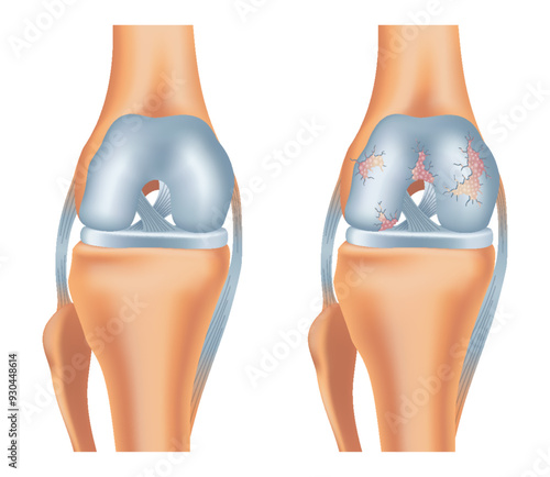 Knee arthrosis. Healthy knee and sore knee with damaged structure. Bone exposure damaged and healthy knee structure comparison. Medical poster with foot bones. Isolated vector illustration
