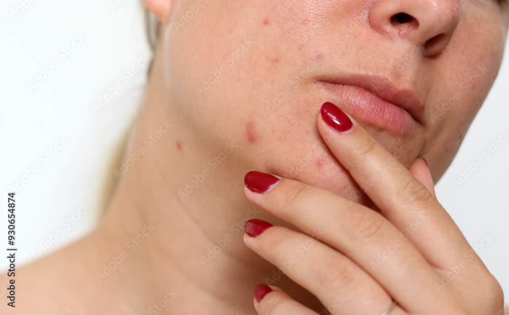 Obraz premium Close up of female face with red problematic acne skin and scars