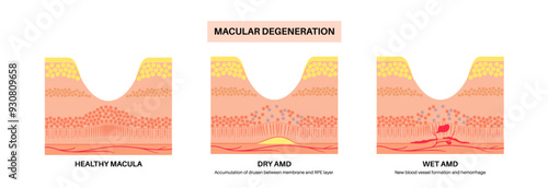Macular degeneration poster