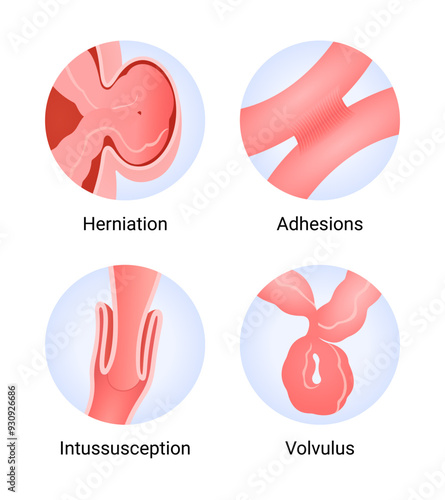 Symptoms and Causes of Bowel Obstruction