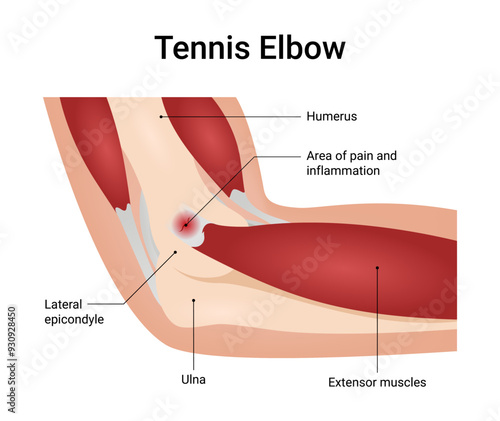 Diagram of Tennis Elbow Causes