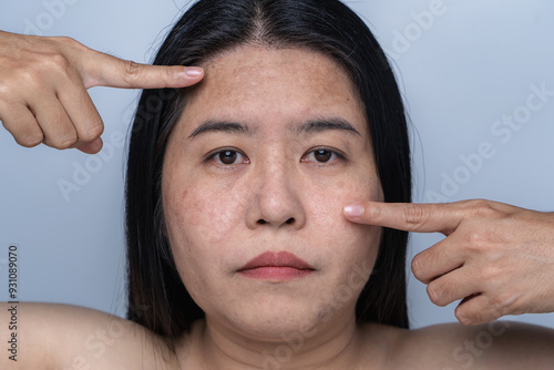 Woman with facial skin problems of freckles, dark spots, and wrinkles on the face Enlarged pores on combination skin Expressing a tense, thoughtful expression Dull and rough skin  Healthy concept. photo