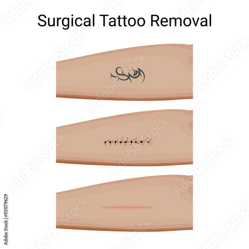 Steps of Surgical Tattoo Removal Process. Vector illustration design.