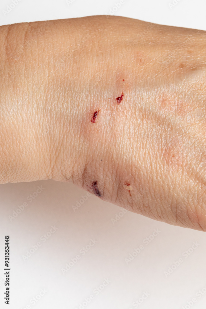 Fototapeta premium Woman showing scratches on her hand from animal attack