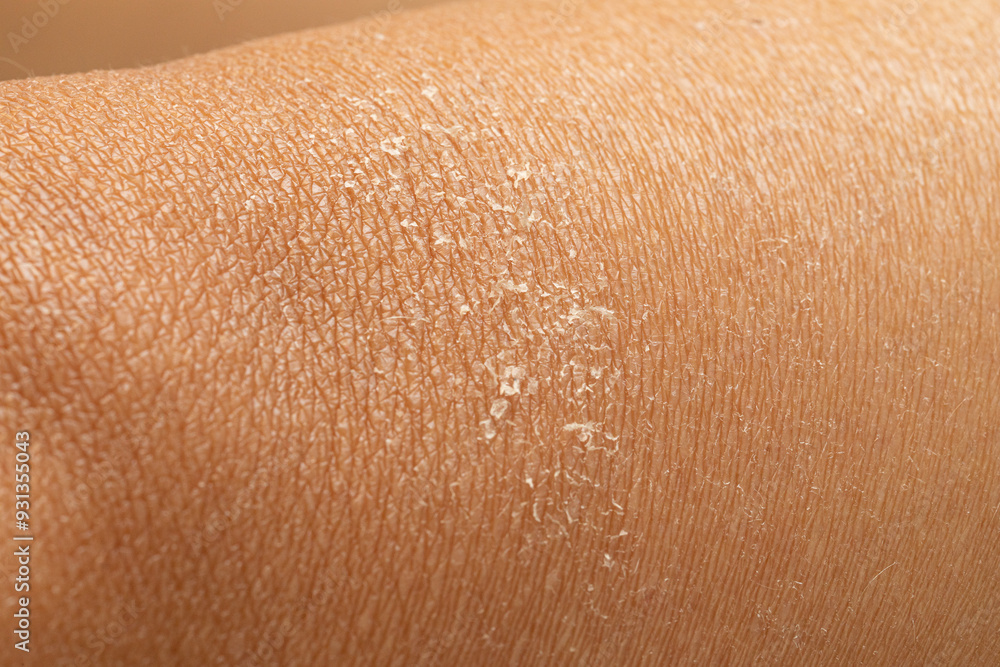 Fototapeta premium Dry human skin of a caucasian woman. Concept of skin rehydration cosmetics