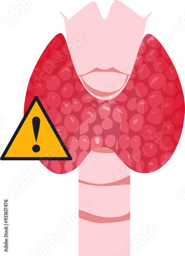 Thyroid disease Illustration 