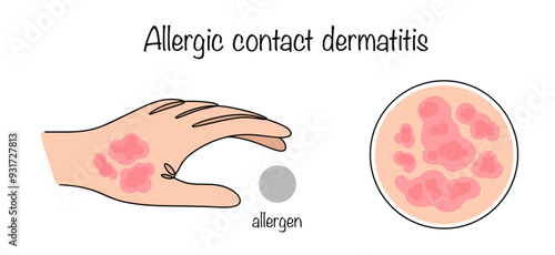 Allergic contact dermatitis