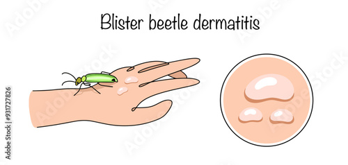 Blister beetle dermatitis