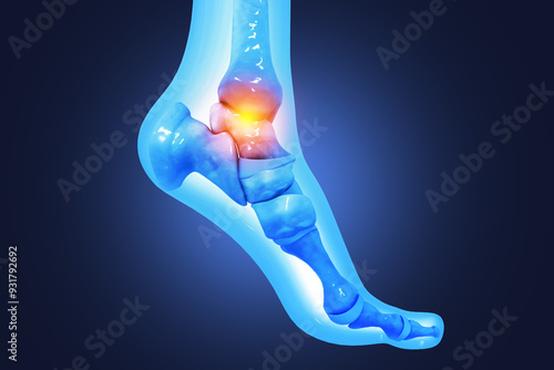 Photography Medical Illustration of foot Anatomy, Inflamed Ankle