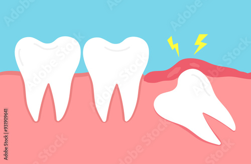 Impacted wisdom tooth. Crooked teeth. Toothache molar. inflamed and swollen gum. Dental care. Vector illustration