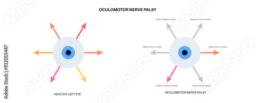 Oculomotor nerve palsy