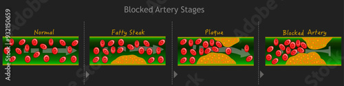 Blocked artery, blood vessels stages, atherosclerosis. Fatty steak, plaque. flow red cells, cardiac bypass. Hardening, clogged arteries. Coronary,  circulatory disease. Dark vector illustration