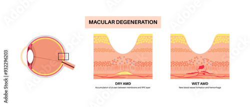 Macular degeneration poster
