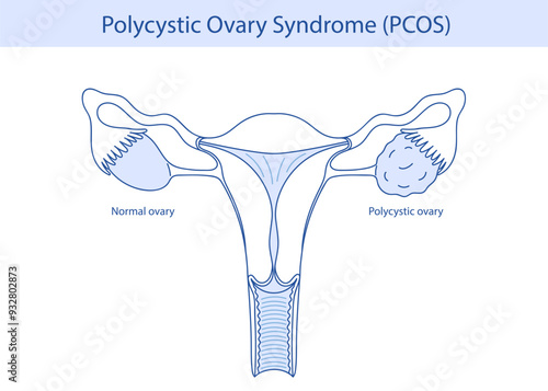 Polycystic ovary syndrome PCOS. Ovarian cysts of the female reproductive system. New Year illustration is hand drawn.
